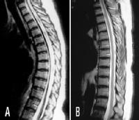 Resonancia magnética de la médula espinal