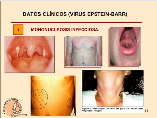 Foto síntomas del virus Estein-Barr