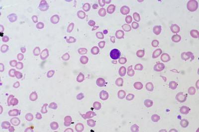 sangre con anemia ferropénica