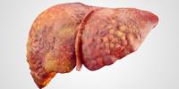 Hígado afectado por cirrosis